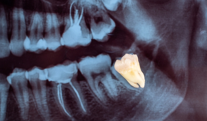 Why experts now say not to remove your wisdom teeth