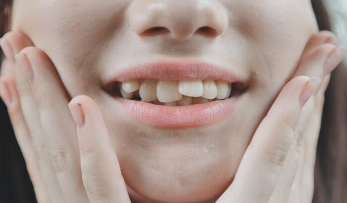 Can you get veneers with crooked teeth?