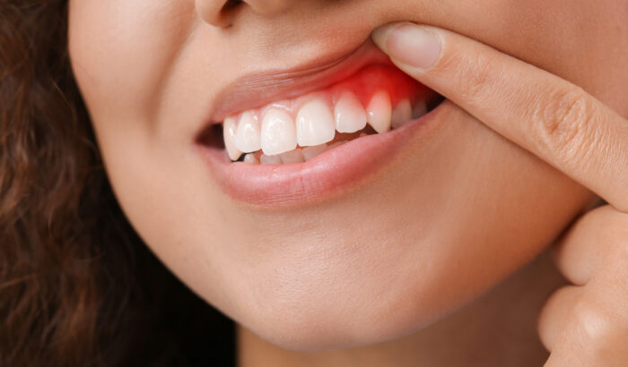Can you have veneers with gum disease?