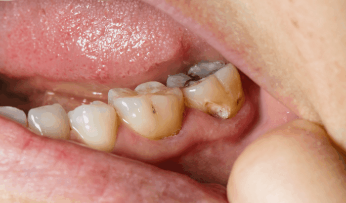 The UK prepares for a wave of post-lockdown tooth decay