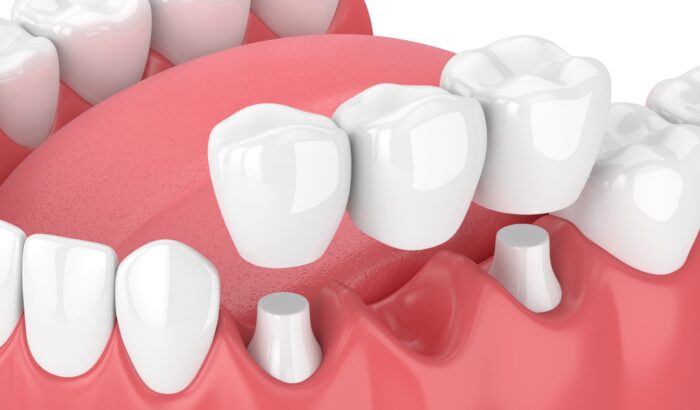 Is a dental bridge permanent?