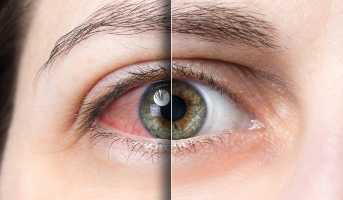 Can dry eyes cause blindness