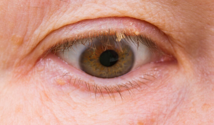 Can I cut a skin tag off my eye