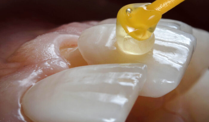 How much do porcelain veneers cost?