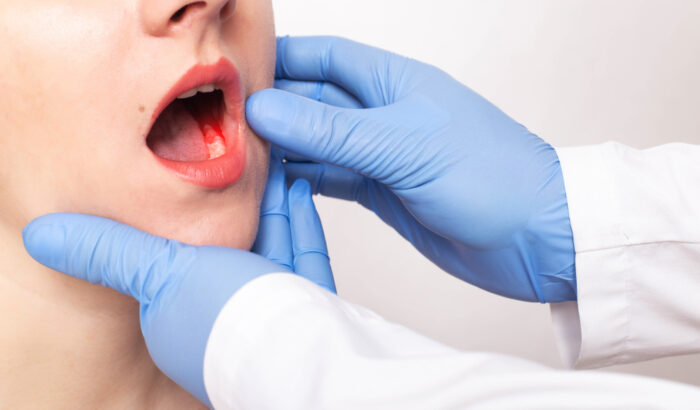 5 Effective ways to stop bleeding after a tooth extraction