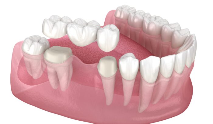 How much does a dental bridge cost privately in the UK?