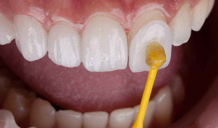 How are veneers fitted?