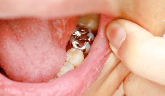 How long after a tooth filling can you eat