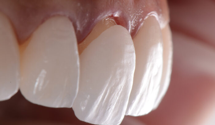 How do veneers look like after 10 years