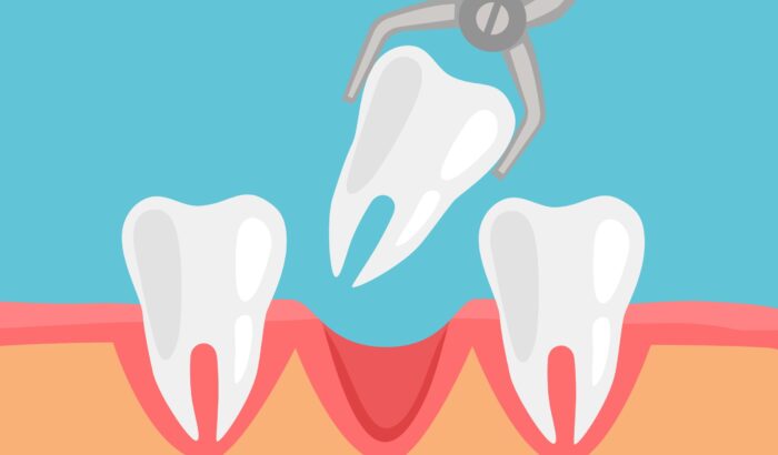 What to expect from a normal socket after tooth extraction
