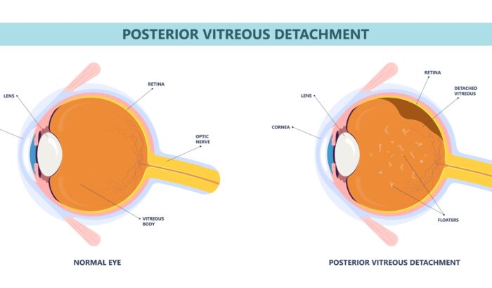 Can dry eyes cause vitreous detachment?