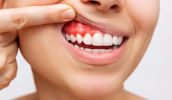 Tips on how to cure gum disease without a dentist