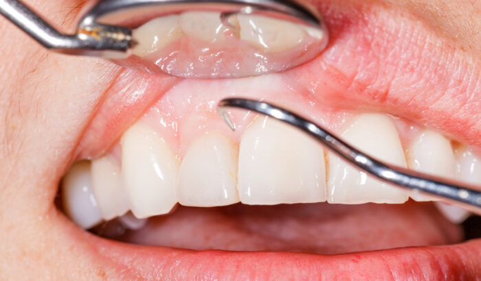 Can you have composite bonding with gum disease
