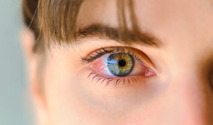 Tired,Eyes,And,Contact,Lenses.,Close,Up.,Green,Eyes,Of