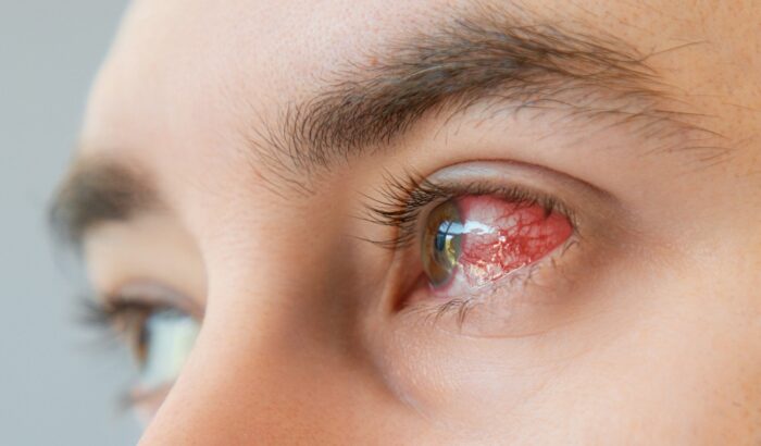 Understanding conjunctivitis: what is it and how does it affect the eye