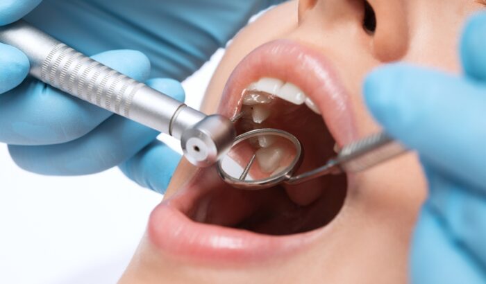 The best material to choose for your tooth filling