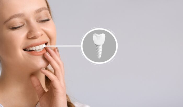 How much are dental implants in the UK?