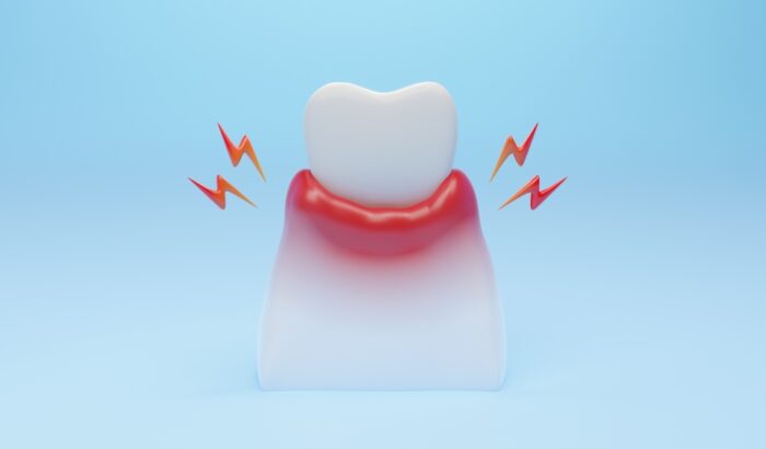 Can periodontal gum disease be reversed