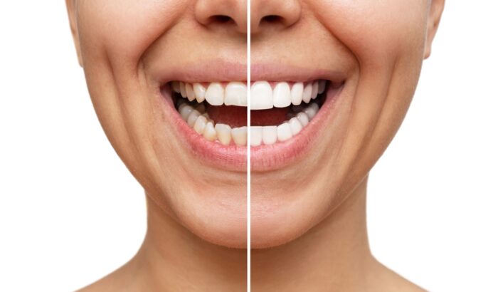 Can you go back to normal teeth after veneers