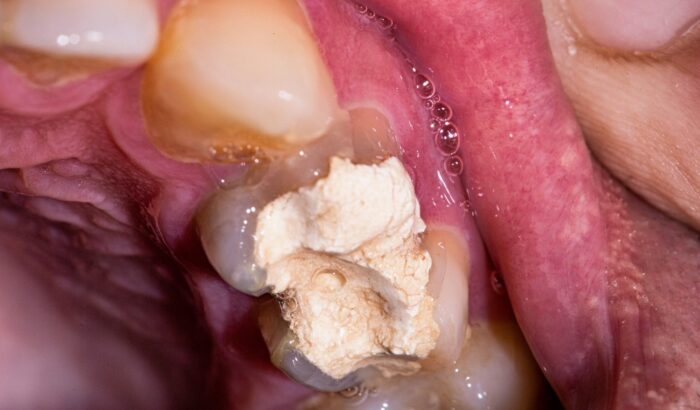 How long does a temporary tooth filling last