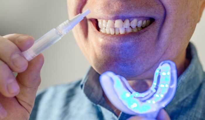 Can you whiten veneers?