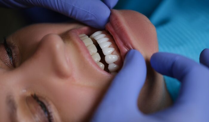 How much do composite veneers cost?