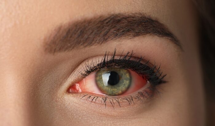 How to treat dry eye syndrome