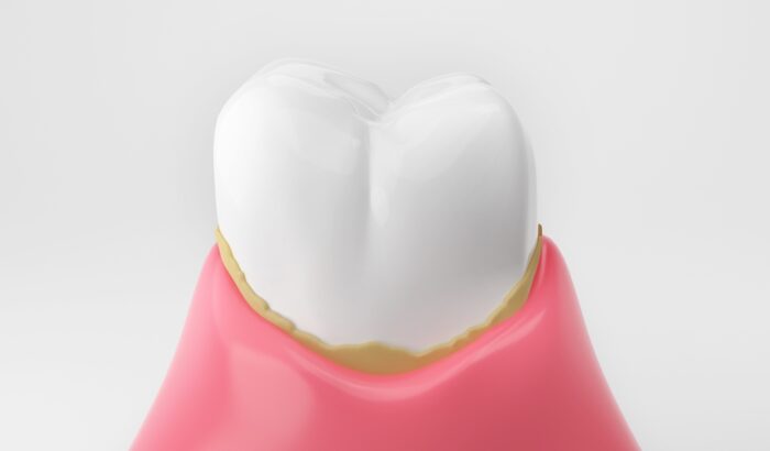 How to remove tartar from dentures instantly