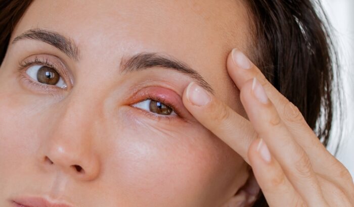 How do you know when a Chalazion is draining?