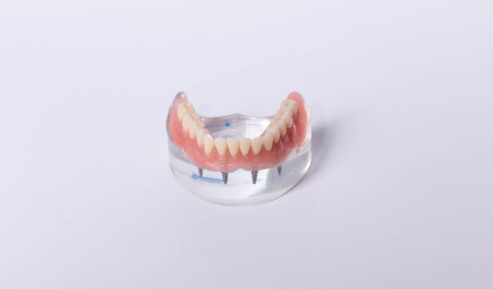 Do dental implants hurt