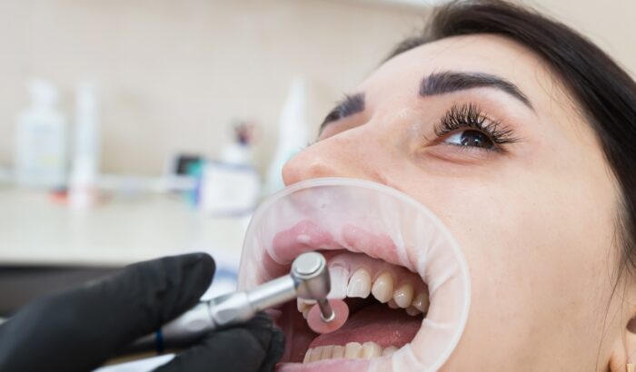 What happens to real teeth under veneers