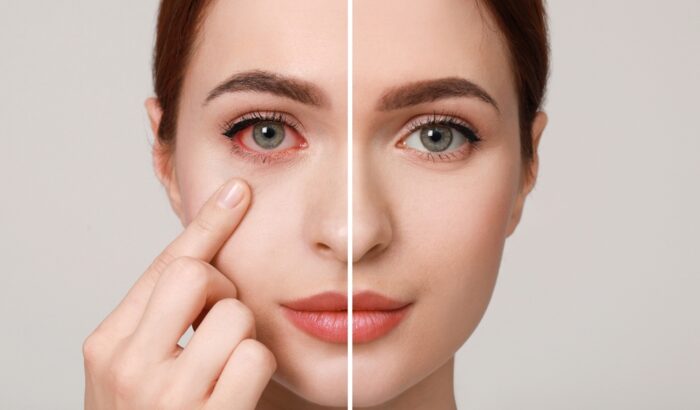 Is Conjunctivitis contagious?