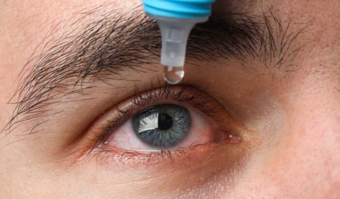 How to treat Conjunctivitis