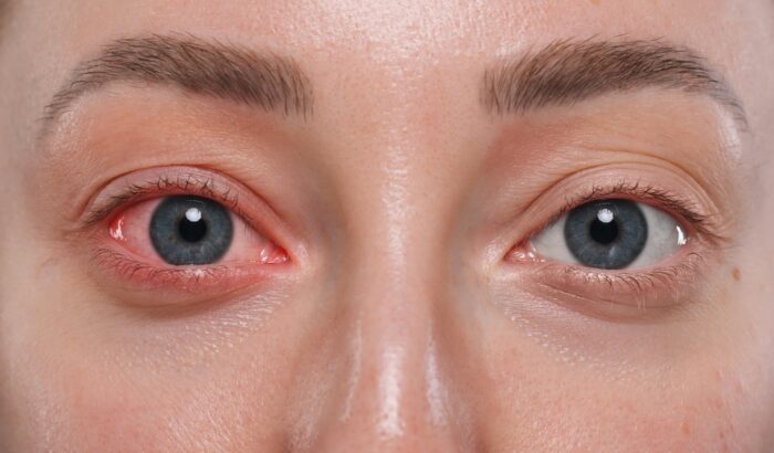 How long does conjunctivitis last?