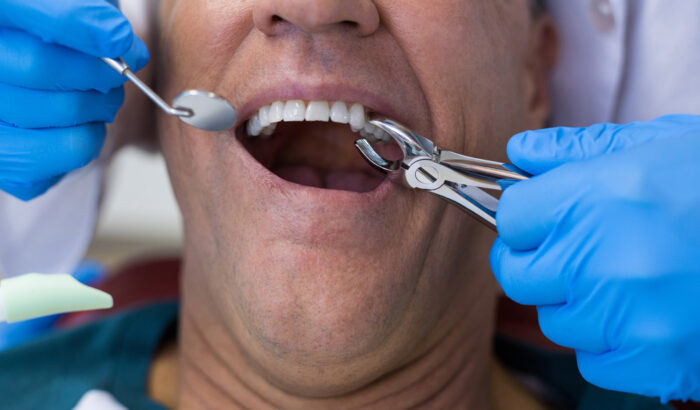 How painful is a tooth extraction?