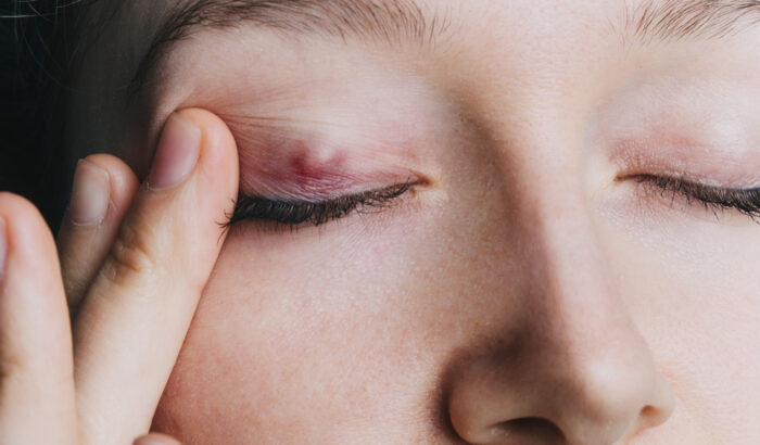 What happens if a chalazion is left untreated?