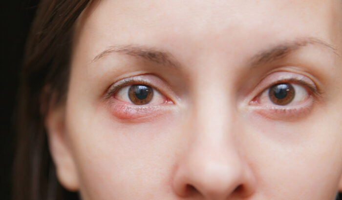 Will hardened chalazion go away?