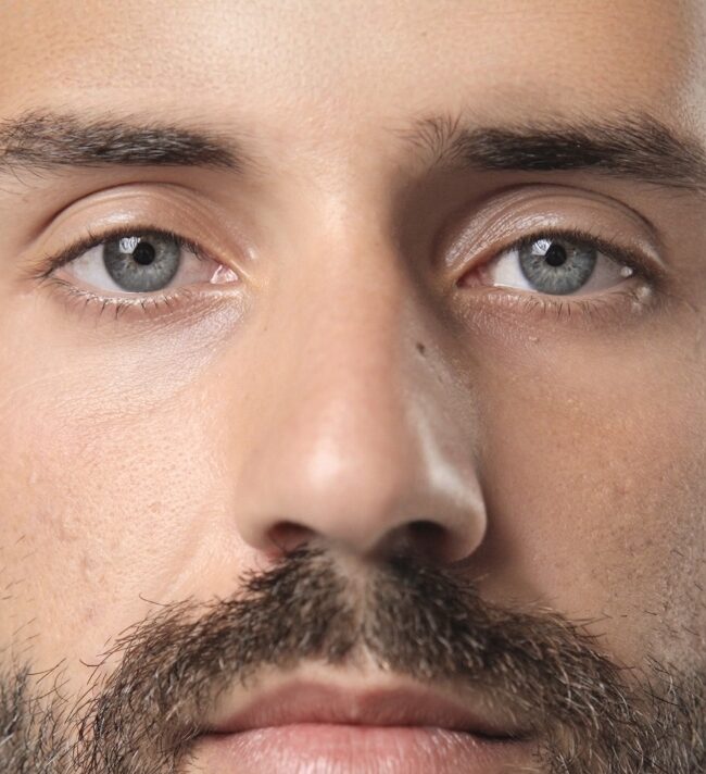 Dry Eyes