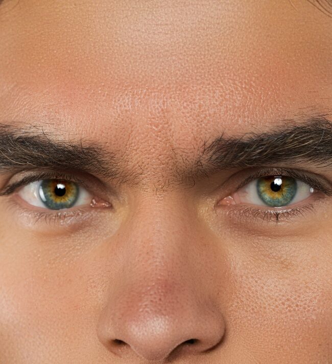 Blepharitis