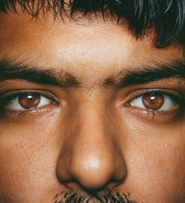 Conjunctivitis