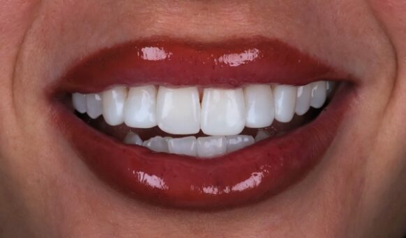 Smile Makeover Case 1 after