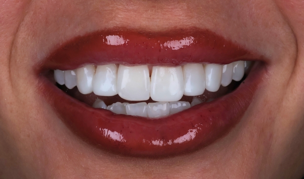 Smile Makeover Case 1 after