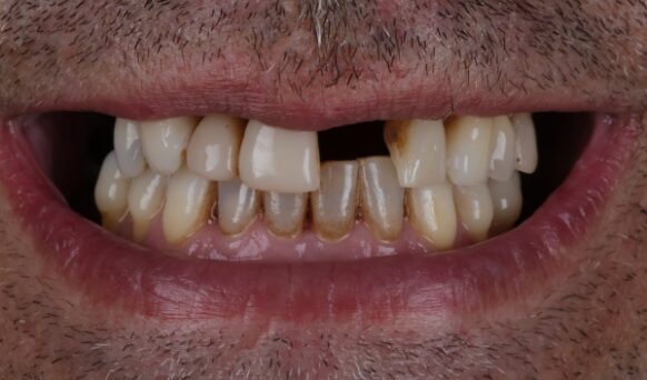 Smile Makeover Case 2 before