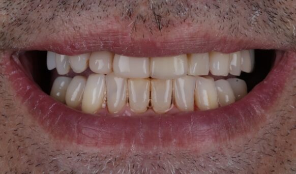 Smile Makeover Case 2 after