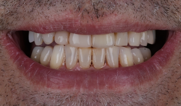 Smile Makeover Case 2 after