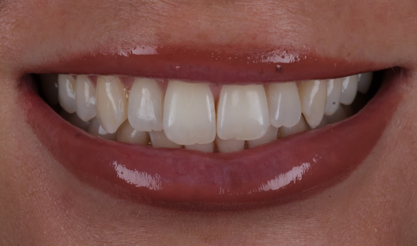 Smile Makeover before