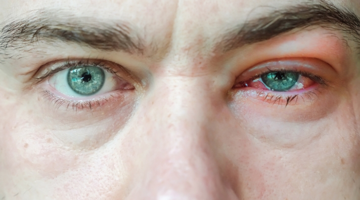 Blepharitis