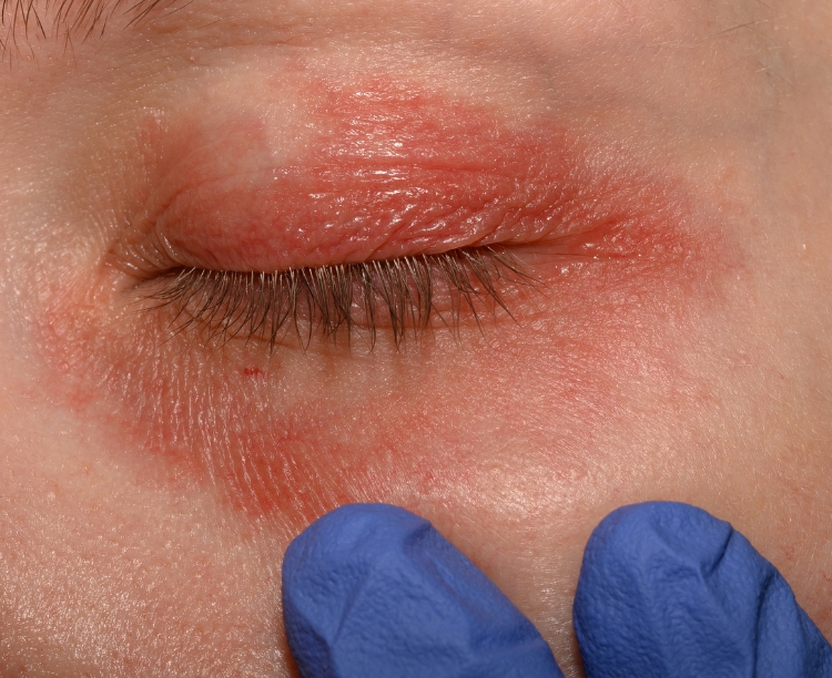 Diagnosing Blepharitis