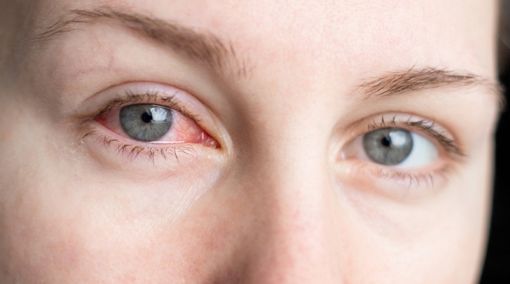 Conjunctivitis